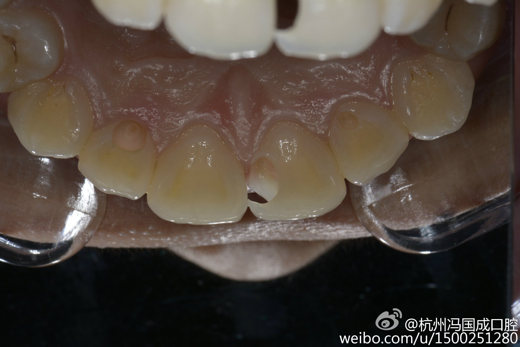 男子用5元树脂补牙口腔变样男子用5元树脂补牙，口腔大变样——牙齿修复的新奇迹